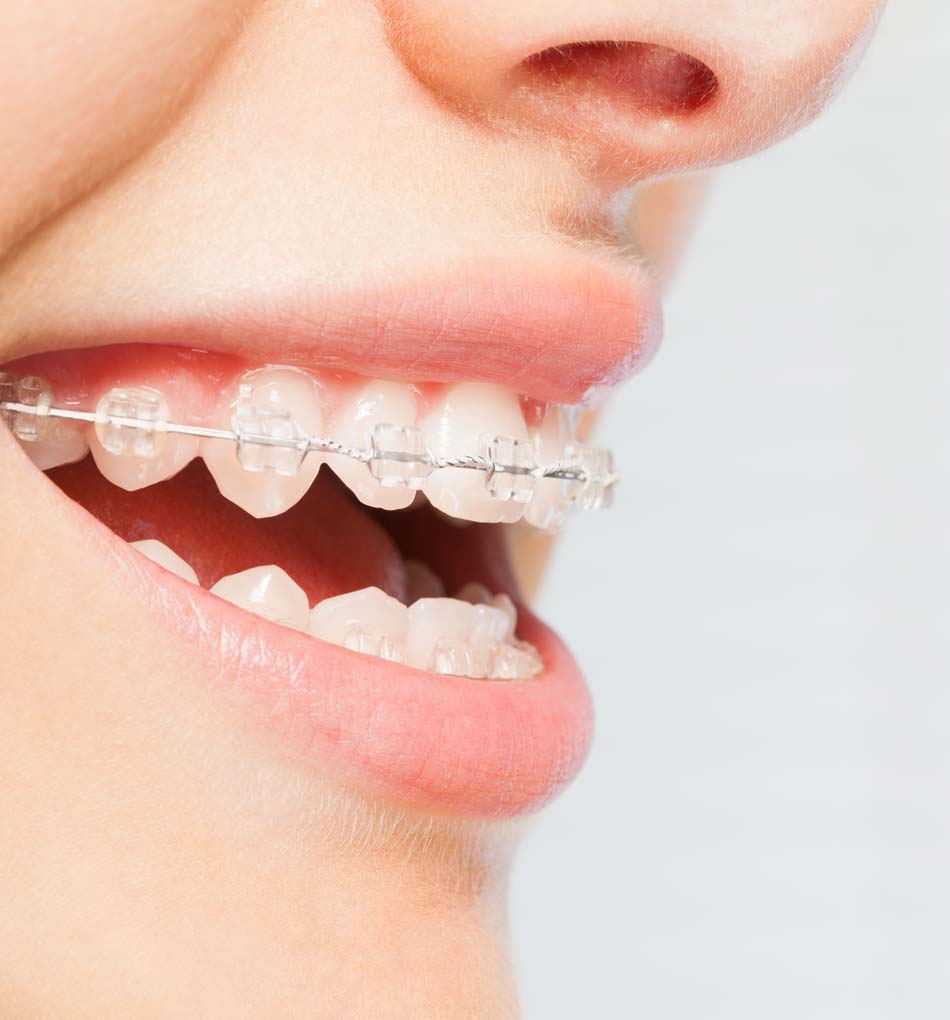 Clear Braces