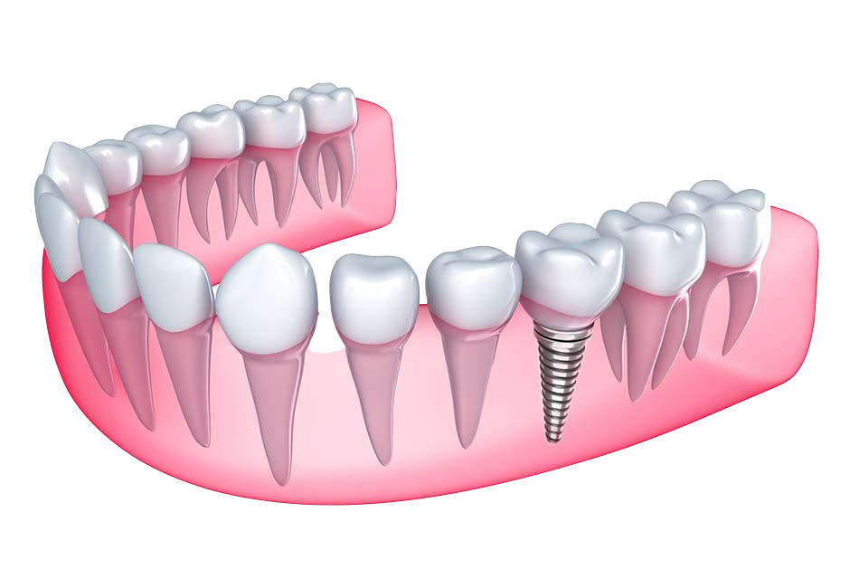 Single Implant
